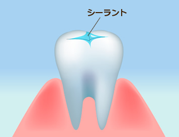 シーラント